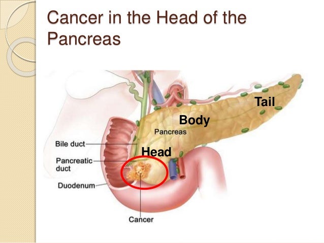 Cáncer de páncreas curado