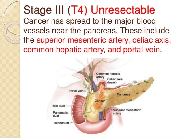 What are the stages of metastatic liver cancer?