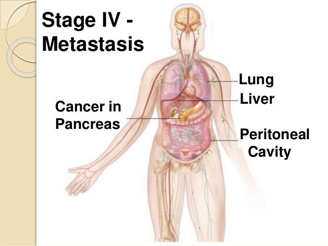Pancreatic cancer spreads to liver