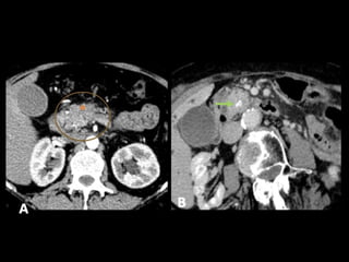 Comprehensive Overview of Pancreatic Neoplasms: Diagnosis and Imaging ...