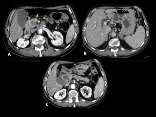 Comprehensive Overview of Pancreatic Neoplasms: Diagnosis and Imaging ...