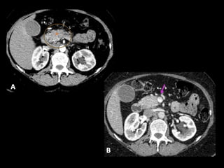Comprehensive Overview of Pancreatic Neoplasms: Diagnosis and Imaging ...