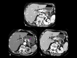 Comprehensive Overview of Pancreatic Neoplasms: Diagnosis and Imaging ...