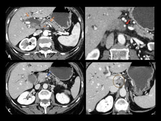 Comprehensive Overview of Pancreatic Neoplasms: Diagnosis and Imaging ...