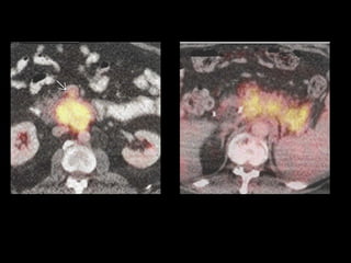 Comprehensive Overview of Pancreatic Neoplasms: Diagnosis and Imaging ...