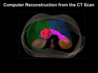 Radiation Therapy for Pancreas Cancer | PPTX