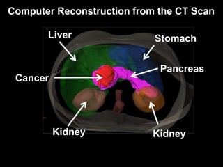 Radiation Therapy for Pancreas Cancer | PPTX