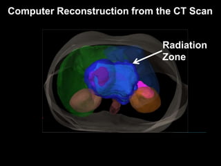 Radiation Therapy for Pancreas Cancer | PPTX