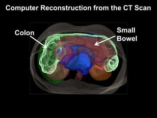 Radiation Therapy for Pancreas Cancer | PPTX