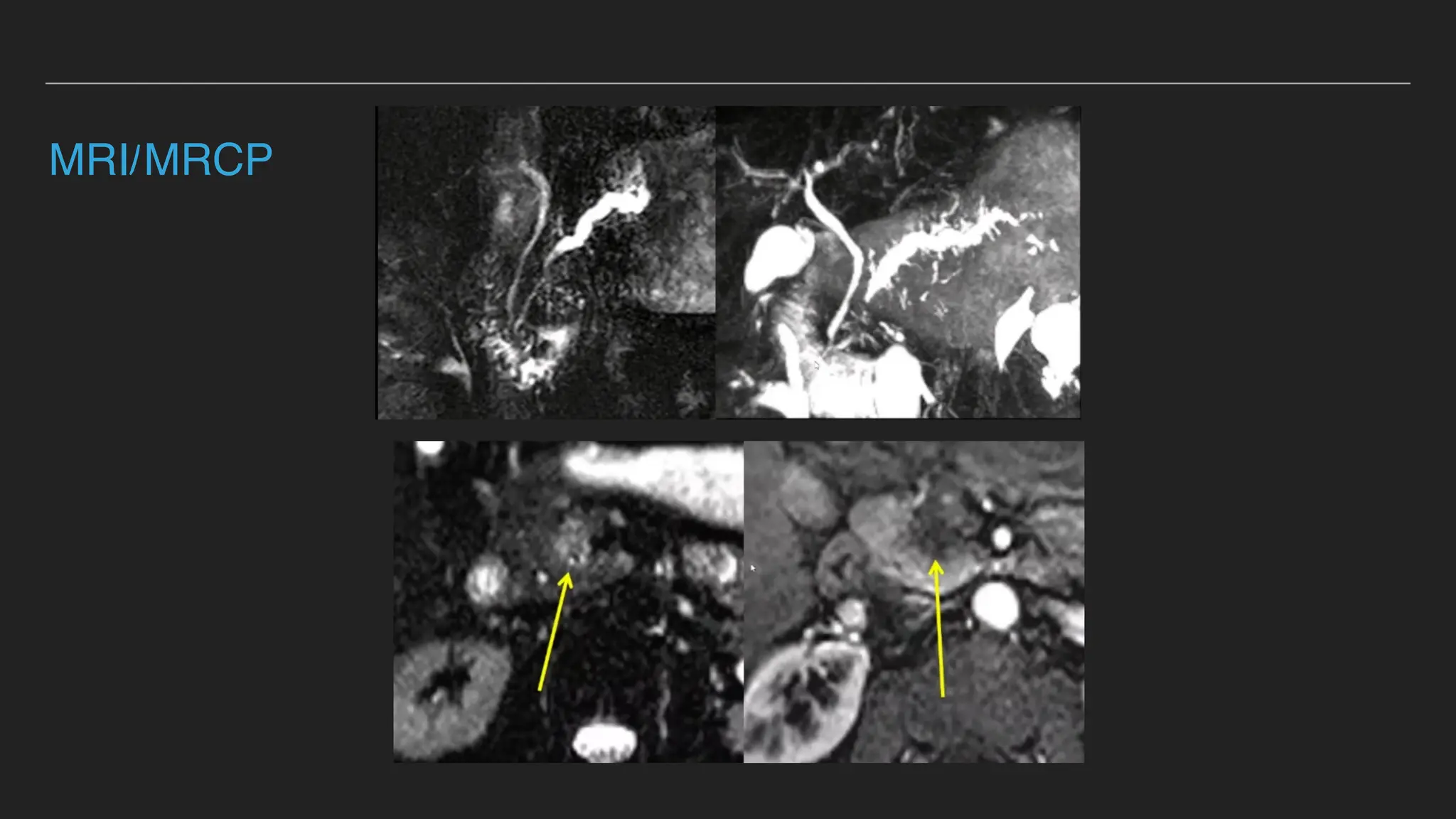 Pancreas cysts123678900008765332235568890 ppt