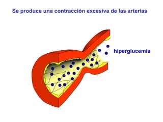 Se produce una contracción excesiva de las arterias 
hiperglucemia 
 
