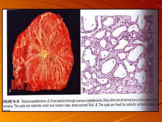 Patho B Pancreas Patho B 2 | PPT