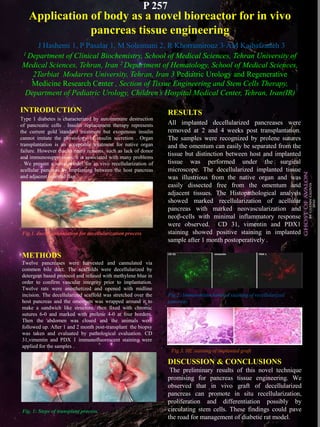 Application of body as a novel bioreactor for in vivo
pancreas tissue engineering
J Hashemi 1, P Pasalar 1, M Soleimani 2, R Khorramirouz 3, AM Kajbafzadeh 3
1 Department of Clinical Biochemistry, School of Medical Sciences, Tehran University of
Medical Sciences, Tehran, Iran 2 Department of Hematology, School of Medical Sciences,
2Tarbiat Modarres University, Tehran, Iran 3 Pediatric Urology and Regenerative
Medicine Research Center , Section of Tissue Engineering and Stem Cells Therapy,
Department of Pediatric Urology, Children’s Hospital Medical Center, Tehran, Iran(IR)
INTRODUCTION
Type 1 diabetes is characterized by autoimmune destruction
of pancreatic cells . Insulin replacement therapy represents
the current gold standard treatment but exogenous insulin
cannot imitate the physiology of insulin secretion . Organ
transplantation is an acceptable treatment for native organ
failure. However due to many reasons, such as lack of donor
and immunosuppression, it is associated with many problems
. We present a novel model for in vivo recellularization of
acellular pancreas by implanting between the host pancreas
and adjacent omental flap.
RESULTS
All implanted decellularized pancreases were
removed at 2 and 4 weeks post transplantation.
The samples were recognized by prolene sutures
and the omentum can easily be separated from the
tissue but distinction between host and implanted
tissue was performed under the surgical
microscope. The decellularized implanted tissue
was illustrious from the native organ and was
easily dissected free from the omentum and
adjacent tissues. The Histopathological analysis
showed marked recellularization of acellular
pancreas with marked neovascularization and
neoβ-cells with minimal inflammatory response
were observed. CD 31, vimentin and PDX1
staining showed positive staining in implanted
sample after 1 month postoperatively .
METHODS
Twelve pancreases were harvested and cannulated via
common bile duct. The scaffolds were decellularized by
detergent based protocol and infused with methylene blue in
order to confirm vascular integrity prior to implantation.
Twelve rats were anesthetized and opened with midline
incision. The decellularized scaffold was stretched over the
host pancreas and the omentum was wrapped around it to
make a sandwich like structure, then fixed with chromic
sutures 6-0 and marked with prolene 4-0 at four borders.
Then the abdomen was closed and the animals were
followed up. After 1 and 2 month post-transplant the biopsy
was taken and evaluated by pathological evaluation. CD
31,vimentin and PDX 1 immunofluorescent staining were
applied for the samples .
Fig.2: Immunohistochemical staining of recellularized
pancreas
DISCUSSION & CONCLUSIONS
The preliminary results of this novel technique
promising for pancreas tissue engineering. We
observed that in vivo graft of decellularized
pancreas can promote in situ recellularization,
proliferation and differentiation possibly by
circulating stem cells. These findings could pave
the road for management of diabetic rat model.
P 257
Fig.3. HE staining of implanted graft
Fig. 1: Steps of transplant process.
Fig.1. ductal cannulation for decellularization process
 