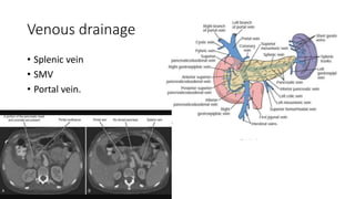 Venous drainage
• Splenic vein
• SMV
• Portal vein.
 