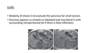 MRI
• Modality of choice in to evaluate the pancreas for small tumors.
• Pancreas appears as smooth or lobulated and may blend in with
surrounding retroperitoneal fat if there is fatty infiltration.
 