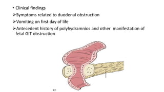• Clinical findings
Symptoms related to duodenal obstruction
Vomiting on first day of life
Antecedent history of polyhydramnios and other manifestation of
fetal GIT obstruction
 