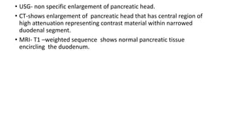• USG- non specific enlargement of pancreatic head.
• CT-shows enlargement of pancreatic head that has central region of
high attenuation representing contrast material within narrowed
duodenal segment.
• MRI- T1 –weighted sequence shows normal pancreatic tissue
encircling the duodenum.
 
