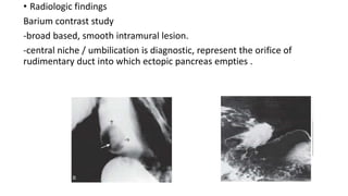 • Radiologic findings
Barium contrast study
-broad based, smooth intramural lesion.
-central niche / umbilication is diagnostic, represent the orifice of
rudimentary duct into which ectopic pancreas empties .
 