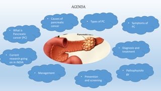 Pancreatic cancer | PPTX