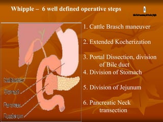 Whipple – 6 well defined operative steps
1. Cattle Brasch maneuver
2. Extended Kocherization
3. Portal Dissection, division
of Bile duct
4. Division of Stomach
5. Division of Jejunum
6. Pancreatic Neck
transection
 