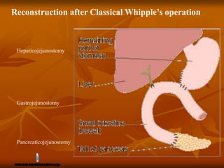 Reconstruction after Classical Whipple’s operation
Hepaticojejunostomy
Gastrojejunostomy
Pancreaticojejunostomy
 