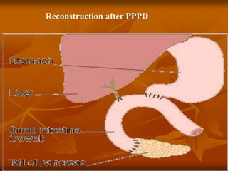 Reconstruction after PPPD
 