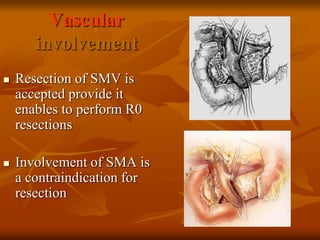 Vascular
involvement
 Resection of SMV is
accepted provide it
enables to perform R0
resections
 Involvement of SMA is
a contraindication for
resection
 