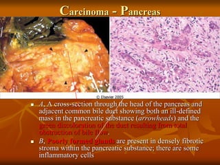 Carcinoma - Pancreas
 A, A cross-section through the head of the pancreas and
adjacent common bile duct showing both an ill-defined
mass in the pancreatic substance (arrowheads) and the
green discoloration of the duct resulting from total
obstruction of bile flow.
 B, Poorly formed glands are present in densely fibrotic
stroma within the pancreatic substance; there are some
inflammatory cells
 