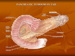 PANCREATIC TUMOURS IN TAIL
 