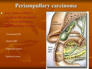 Periampullary carcinoma
 Any tumor within 2
cm from the duodenal
papilla is defined as
periampullary cancer.
Ca terminal PD
Distal CBD
Ampullary tumor
Duodenal tumor
 