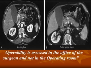 “Operability is assessed in the office of the
surgeon and not in the Operating room”
 