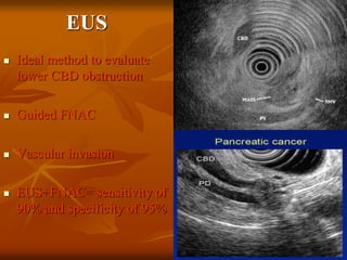 EUS
 Ideal method to evaluate
lower CBD obstruction
 Guided FNAC
 Vascular invasion
 EUS+FNAC= sensitivity of
90% and specificity of 95%
 