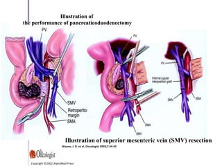 Pancreatic carcinoma dr mnr