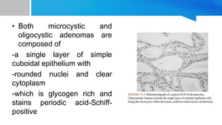 • Both microcystic and
oligocystic adenomas are
composed of
-a single layer of simple
cuboidal epithelium with
-rounded nuclei and clear
cytoplasm
-which is glycogen rich and
stains periodic acid-Schiff-
positive
 