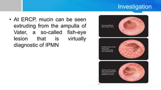 Investigation
• At ERCP, mucin can be seen
extruding from the ampulla of
Vater, a so-called fish-eye
lesion that is virtually
diagnostic of IPMN
 
