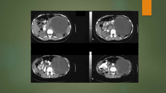 Pancreatic cystic neoplasm: Definition, Classification, Diagnosis and ...