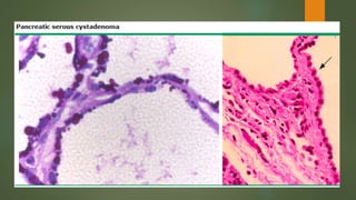 Pancreatic cystic neoplasm: Definition, Classification, Diagnosis and ...