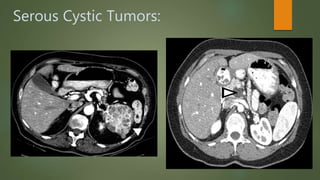 Pancreatic cystic neoplasm: Definition, Classification, Diagnosis and ...