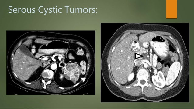 Serous Cystic Tumors Serous Cystic Tumors