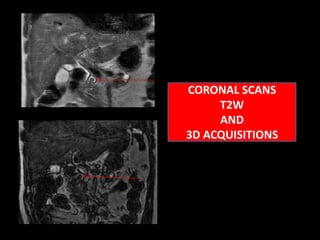 HYPERTHYROIDISM (change of pancreatic juice composition with formation of protein emboli and susequent concretions) TYPES TRUE CALCULUS