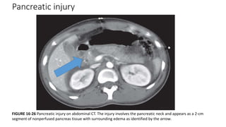 Pancreatic injury
FIGURE 16-26 Pancreatic injury on abdominal CT. The injury involves the pancreatic neck and appears as a 2-cm
segment of nonperfused pancreas tissue with surrounding edema as identified by the arrow.
 