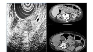 Comprehensive Imaging and Diagnosis of Solid Pancreatic Lesions | PPTX