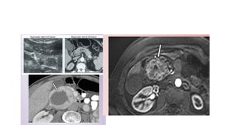 Comprehensive Imaging and Diagnosis of Solid Pancreatic Lesions | PPTX