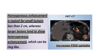 Comprehensive Imaging and Diagnosis of Solid Pancreatic Lesions | PPTX