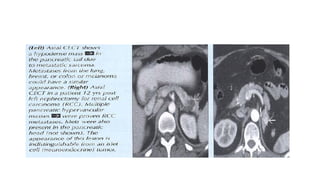 Comprehensive Imaging and Diagnosis of Solid Pancreatic Lesions | PPTX
