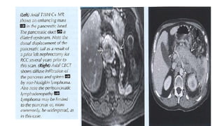 Comprehensive Imaging and Diagnosis of Solid Pancreatic Lesions | PPTX