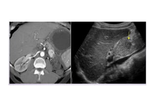 Comprehensive Imaging and Diagnosis of Solid Pancreatic Lesions | PPTX