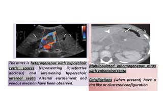 Comprehensive Imaging and Diagnosis of Solid Pancreatic Lesions | PPTX