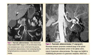 Comprehensive Imaging and Diagnosis of Solid Pancreatic Lesions | PPTX