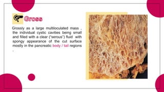 Grossly as a large multiloculated mass ,
the individual cystic cavities being small
and filled with a clear (“serous”) fluid with
spongy appearance of the cut surface
mostly in the pancreatic body / tail regions
.
 
